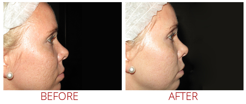 before after collagenpin microneedling scars