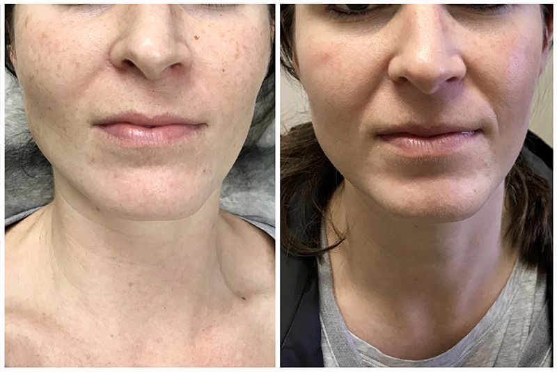 before after ipl laser