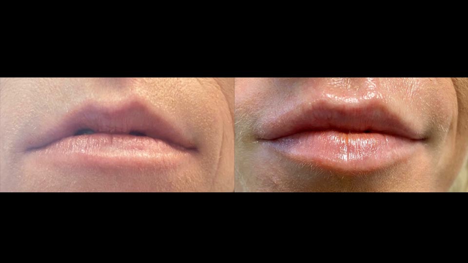 before after juvedermvolbella asymmetrical