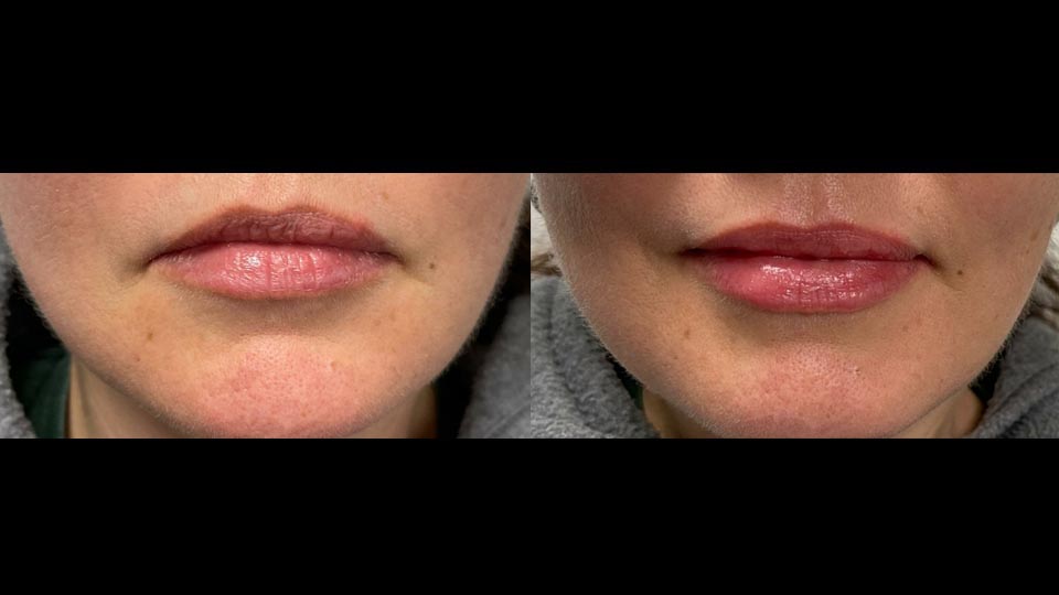 before after juvedermvolbella recovery