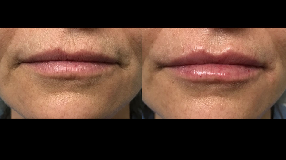 before after juvedermvolbellafillerinjection