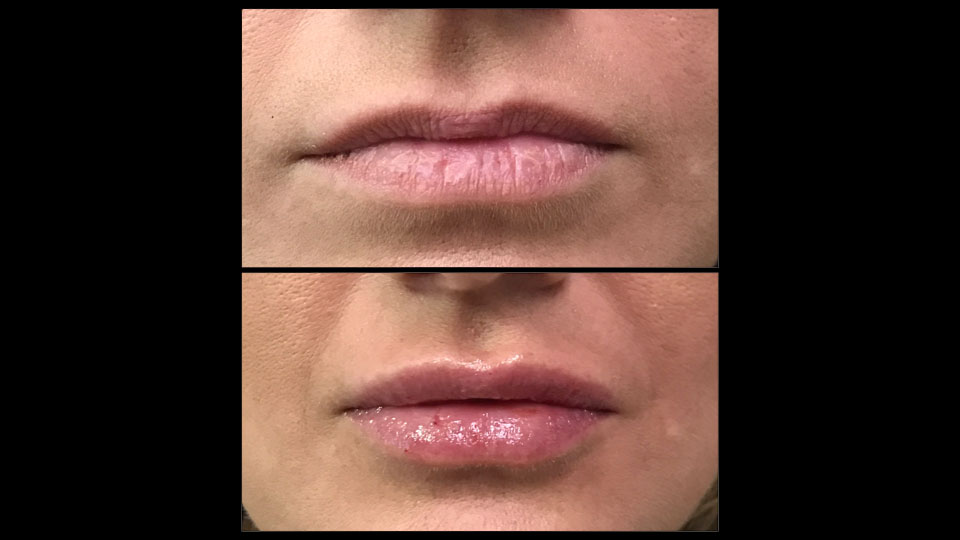 before after juvedermvollurefillerinjection