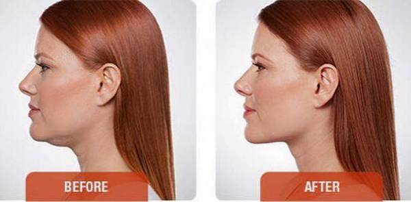 before after kybella