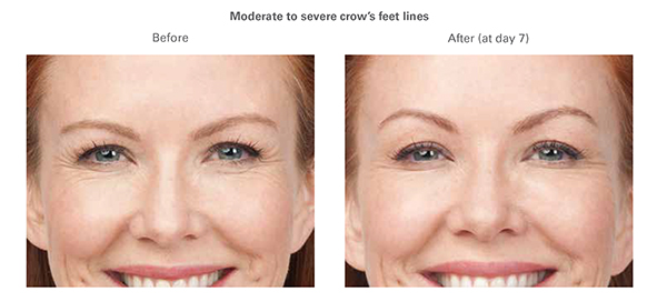 injectables BOTOX®1