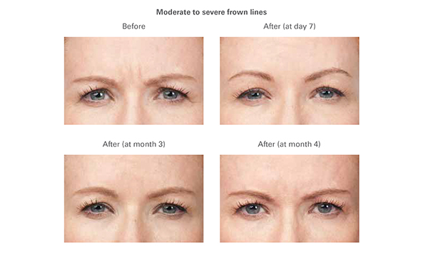 injectables BOTOX®2
