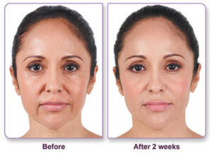 A before and after image of a client who received a Botox treatment
