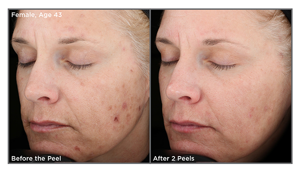 service peels before after