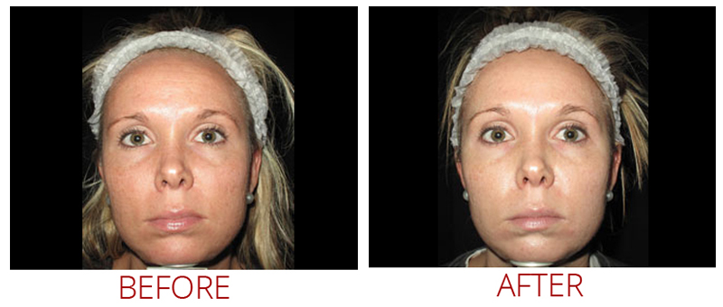 services microneedling darkspots