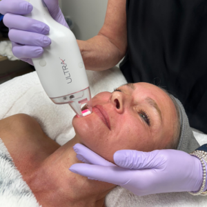 a client receiving an Ultra Laser treatment from one of The Skin Clinics' estheticians