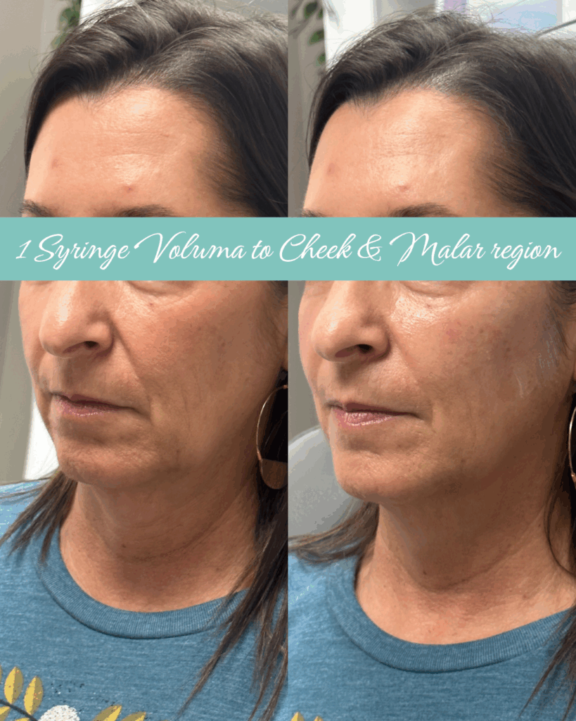 1 syringe voluma to cheek & marlar region