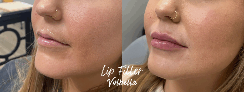 lip filler