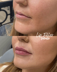 lip filler using volbella