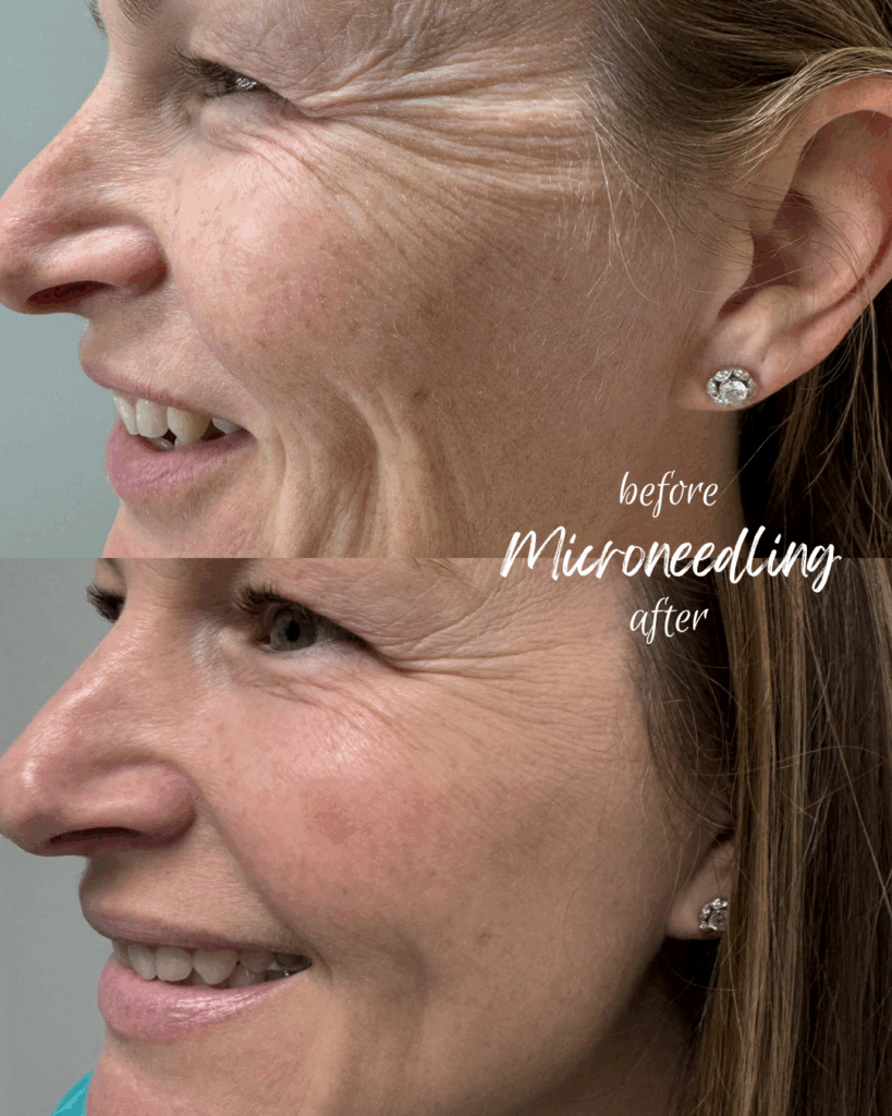 microneedling b&a (1)