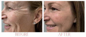 services microneedling wrinkles & fine lines