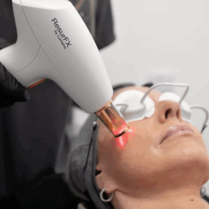 resurfx full face