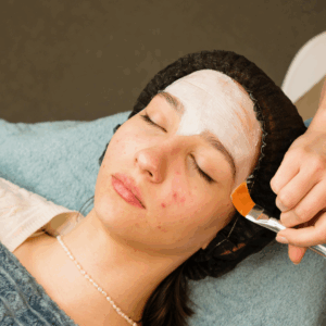acne facial