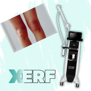 xerf knees germantown only